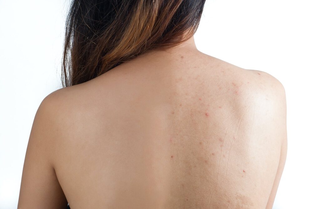 Back Cheeks The Back Facial: Addressing that Hard-to-Reach Spot - Touch To Heal Spa