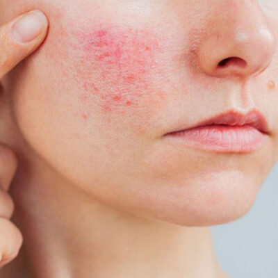 Woman with rosacea-prone skin showing visible facial redness and sensitivity