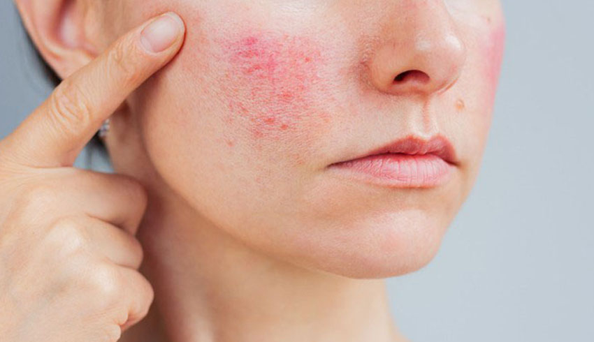 Woman with rosacea-prone skin showing visible facial redness and sensitivity
